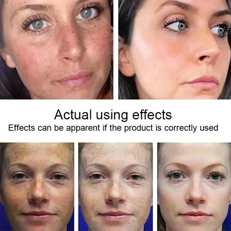 Niacinamide Melasma Brightening Cream Reduce Melanin Brighten Lighten Dark Skin Chloasma Repair Serum Face Care Products