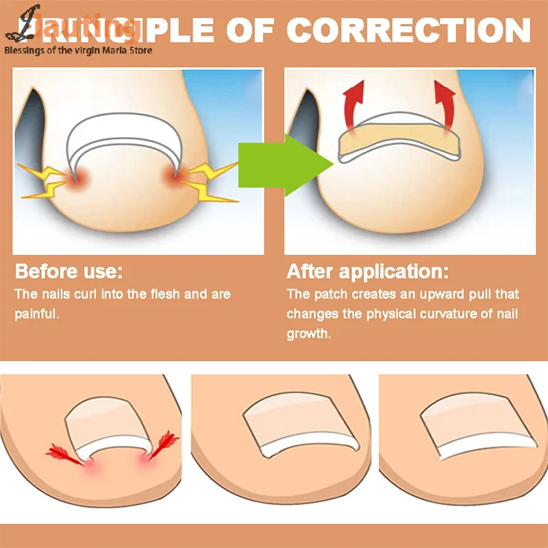 60 Stück ein gewachsene Nagel korrektur Aufkleber Zehen nagel korrektor Patches Paronychie Behandlung erholen Korrektor Pediküre Nagel pflege Werkzeug