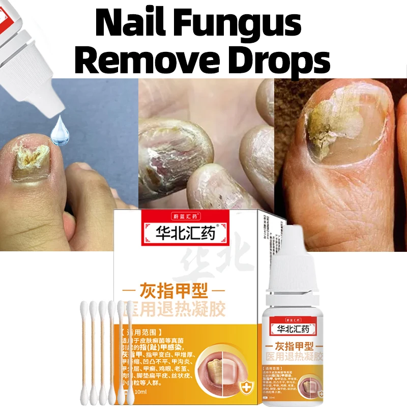 Fungal Nail Treatment Essence Oil Feet Nails Paronychia Repair Care Anti Infection Onychomycosis Removal Serum 10ml