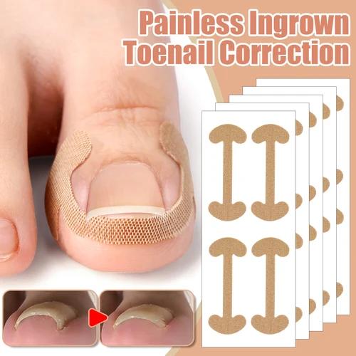 Imagen 2 del producto Parche adhesivo para uñas de los pies, pegatina de corrección de uñas encarnadas, Corrector de pies, almohadilla para tratamiento de salud y pedicura, herramientas para el cuidado de los dedos, 20-100 Uds.