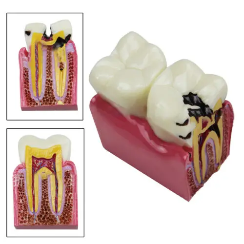 Модель зубов для обучения пациента: 6X модель для сравнения кариеса для эффективного обучения и обучения-идеально подходит для полости рта