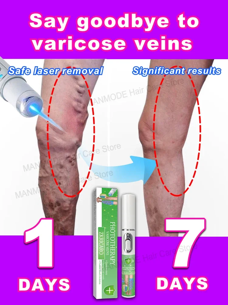 Laser Varicose Vein Products