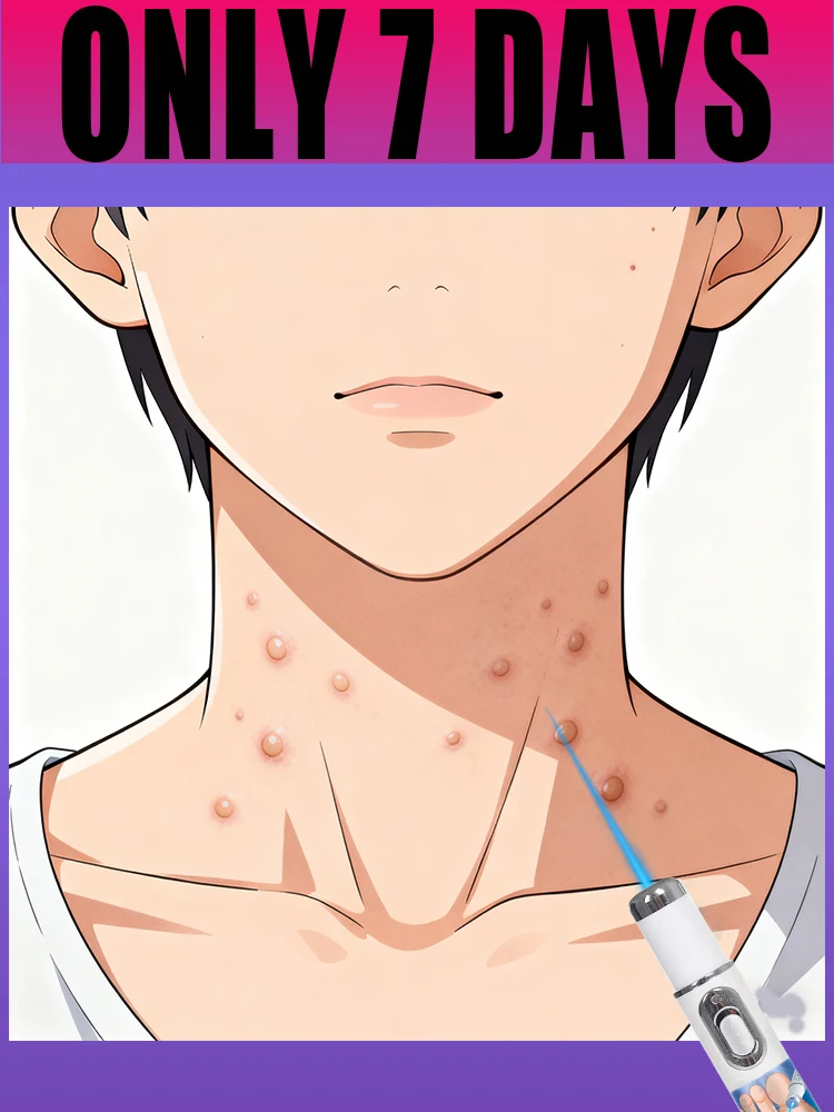 

blue laser light pen care wart tool gentlely for skin