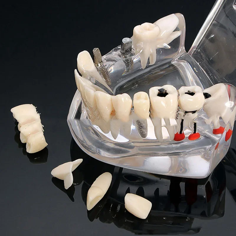 Dental Implant Model Tooth for Dentist Training Teaching Study Tool Dental Disease Simulation Teeth Anatomy Replica