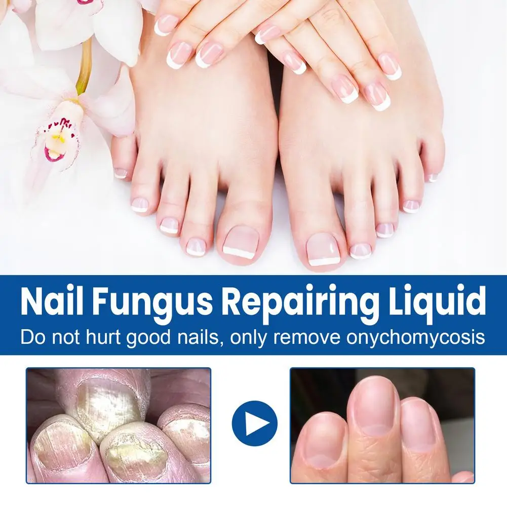Traitement fongique des ongles, Essence de soin des pieds, réparation des ongles des orteils, huiles d'élimination des champignons, Anti-Infection, Paronychia, onychomycose