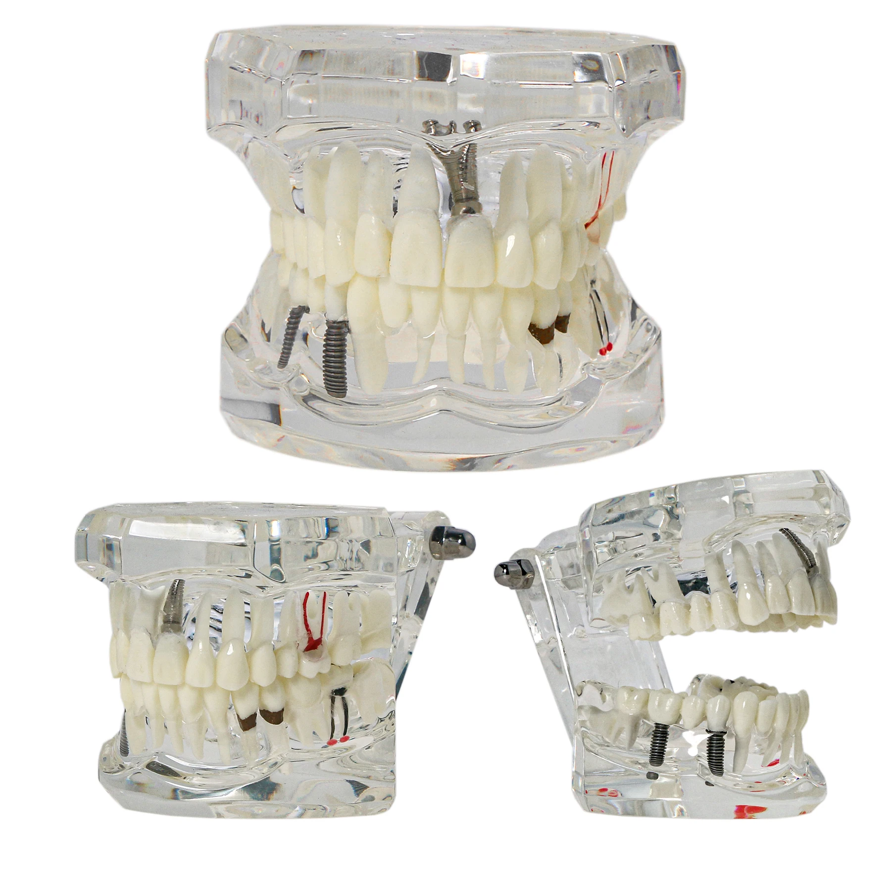 Dental Implant Restoration Pathology Teach Study Teeth Model M2001C Practice Training Dental Teaching Learning Demonstration