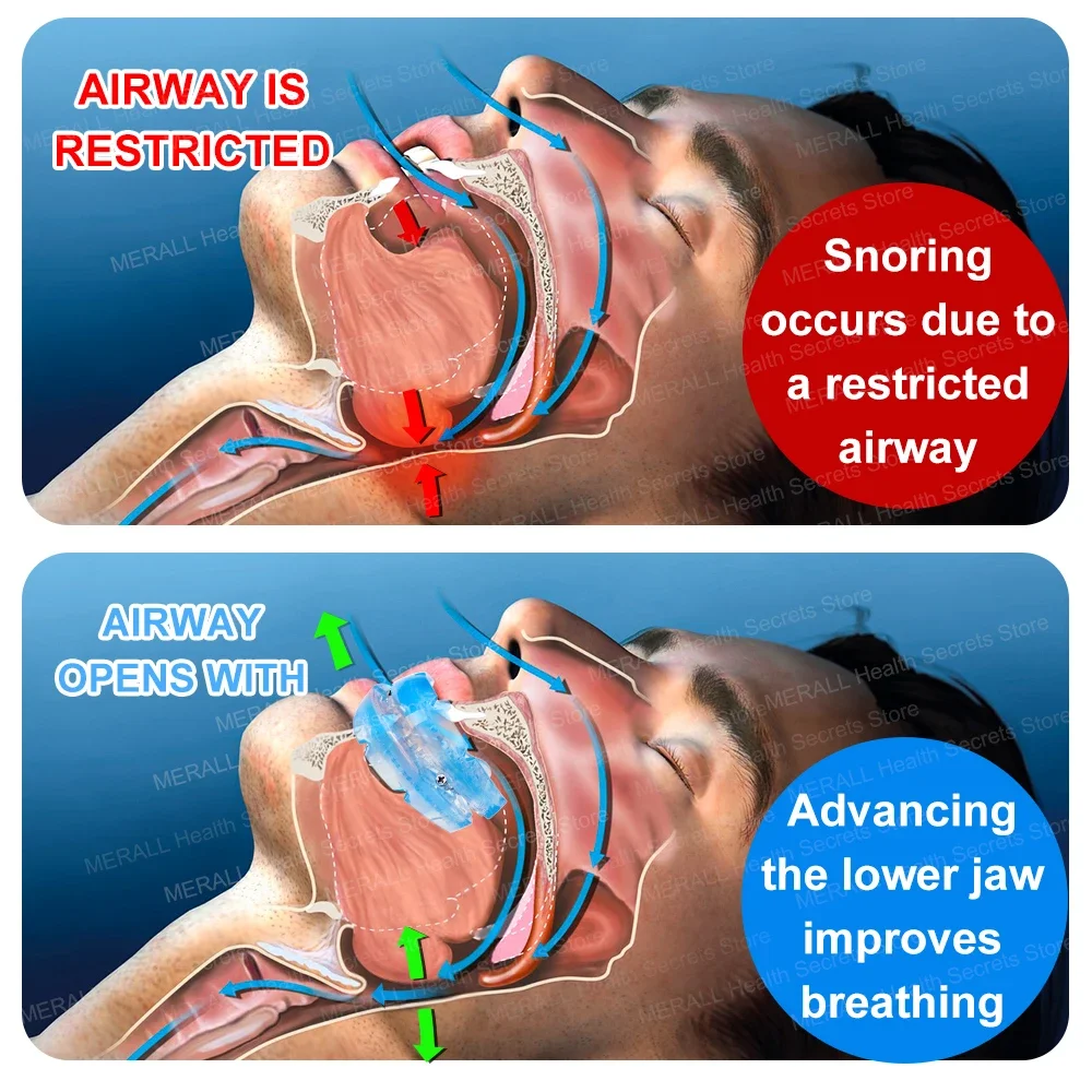 

Anti Snoring Bruxism Mouth Guard Stop Snoring Mouthpiece Sleeping Aid for Men Women Anti-Snoring Devices Braces Correction Safe