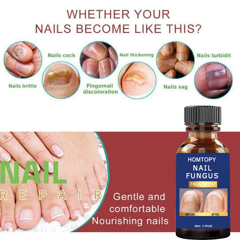 Nail Fungus Treatment Oil Feet Nails Repair Extra Strong Care Essence Anti Infection Paronychia Toe Fungal Removal Essence 50ml