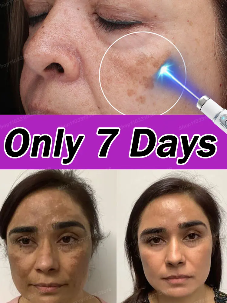 

Facia Dark Spots