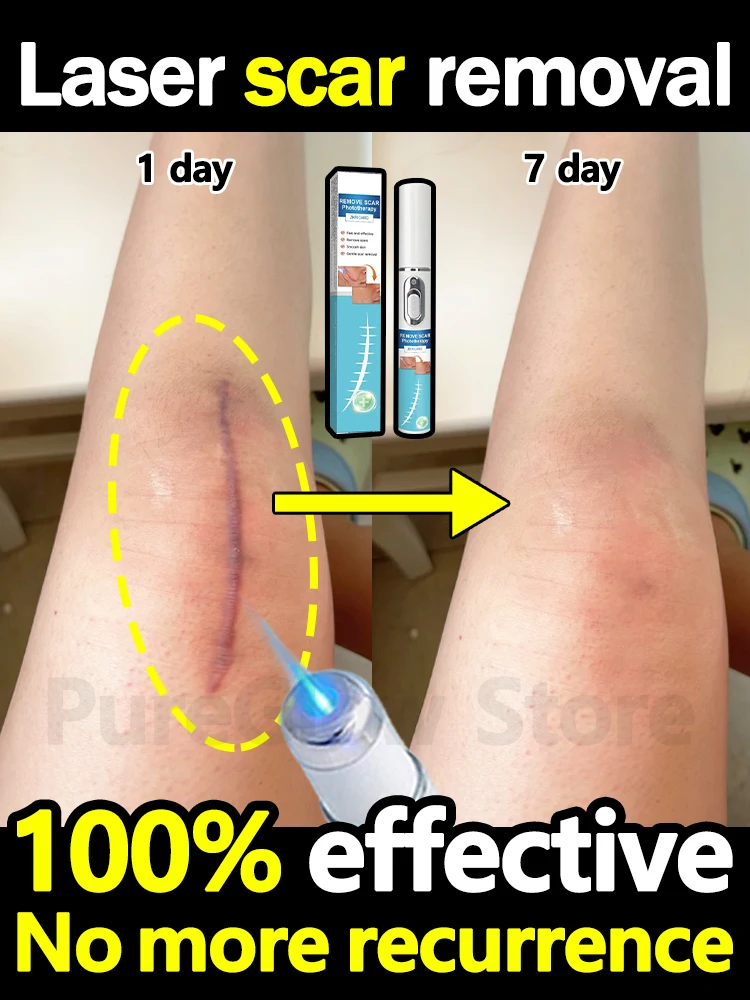 Scars disappear, blue light accelerates repair and promotes regeneration (latest model)