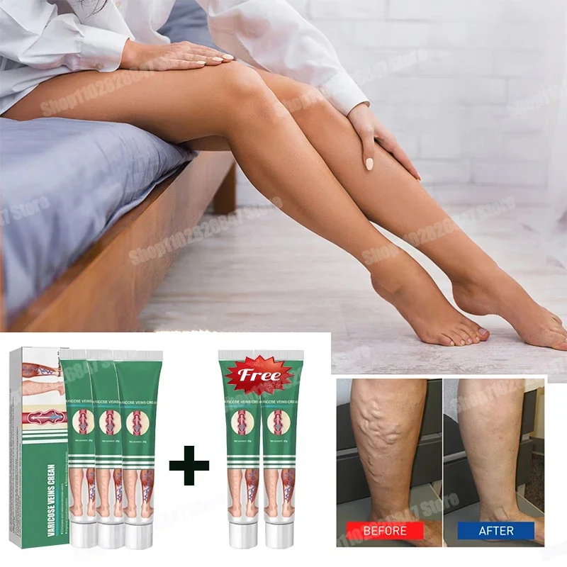 Leg varicose veins reduce swelling and improve spider webs