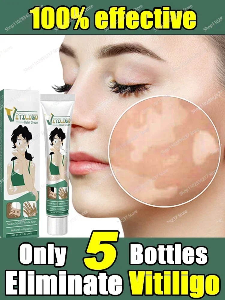 

Effectively Remove Vitiligo Ointment Ringworm White Spot Removal Skin Vitiligo Skin Care 0924