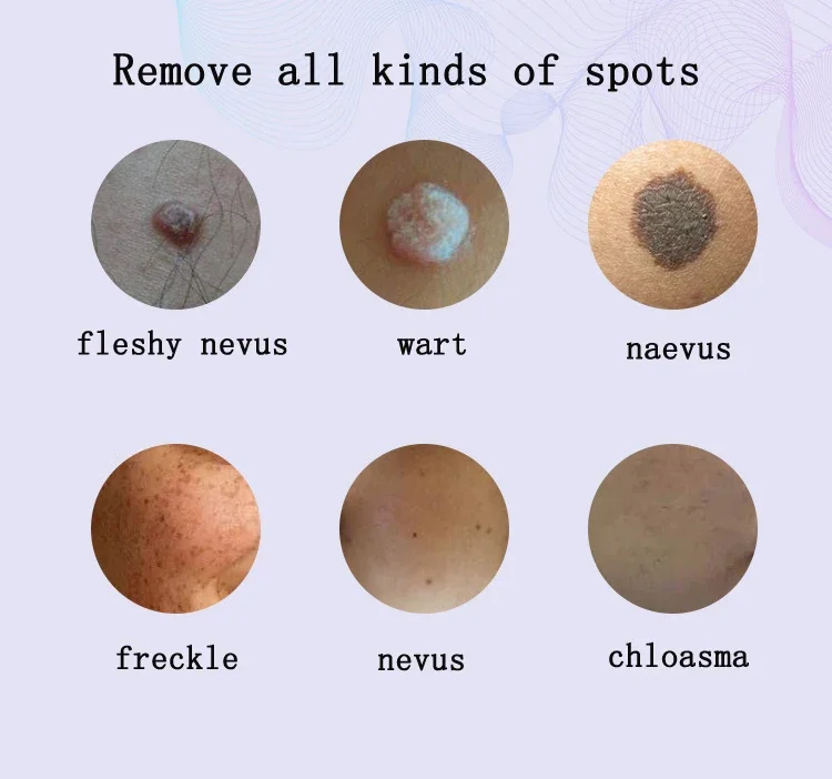 Removing nevi, spot nevi, spot scanning machine, beauty nevi pen, scanning pen, removal instrument, beauty