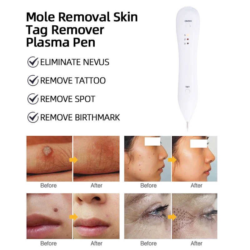 Caneta Plasma Profissional para Remoção de Toupeira, Pele Tag, Sardas, Manchas Pretas, Papilomas, Verrugas, Moles, Tatuagens, Ferramentas de Beleza