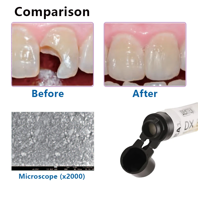 Dental Enamel Light Curing Composite Resin Esthetic Nano Hybrid DX.Incisal Light Cure Resin Anterior Teeth Restoration Dentistry