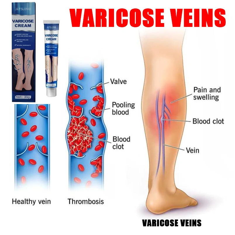 

23cosmetologyVaricosity Blood Vessel Swelling Plaste Vasculitis Phlebitis Spider Legs Treatment Ointment Varicose Veins Cream