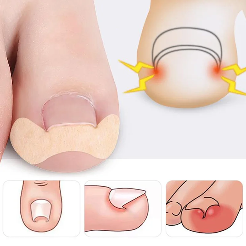 20-100pcs Professional Ingrown Toenail Foot Corrector Stickers Elasticity Toe Nail Care Pedicure Tools Toe Health Care Protects