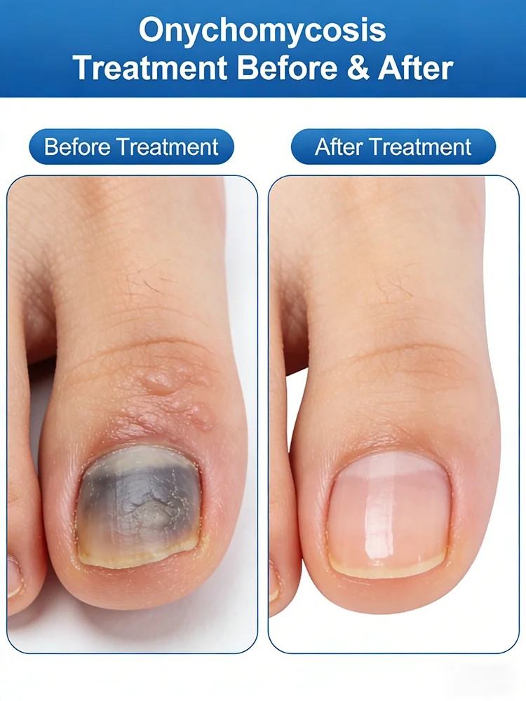 

Хит продаж 2026 года: Эссенция второго поколения для восстановления ногтей и лечения онихомикоза, противогрибковое средство для ногтей на руках и ногах.