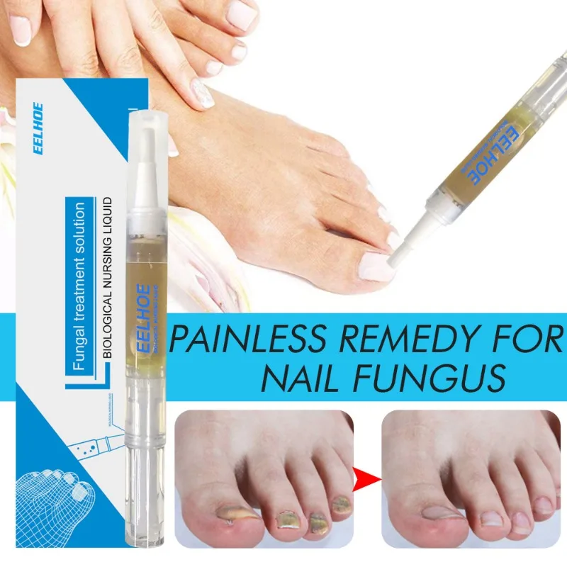 Lápiz líquido para reparación de hongos en las uñas, Gel de reparación de onicomicosis, paroniquia, antiinfección, eliminación de hongos en los dedos de los pies y manos