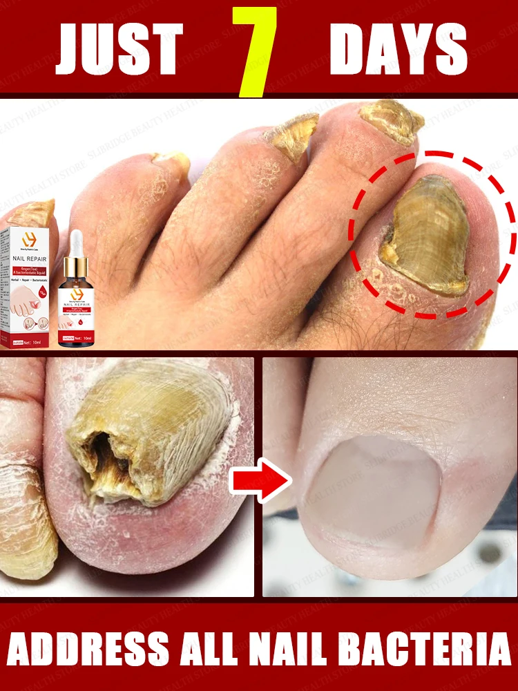 Are you still worried about your nail health?