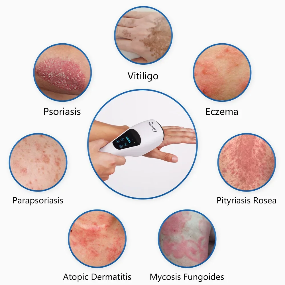 SIGMA SQ1DJ 308nm LED Light Therapy Targeted Device for Vitiligo Treatment s kin Lesion Care Medical Use