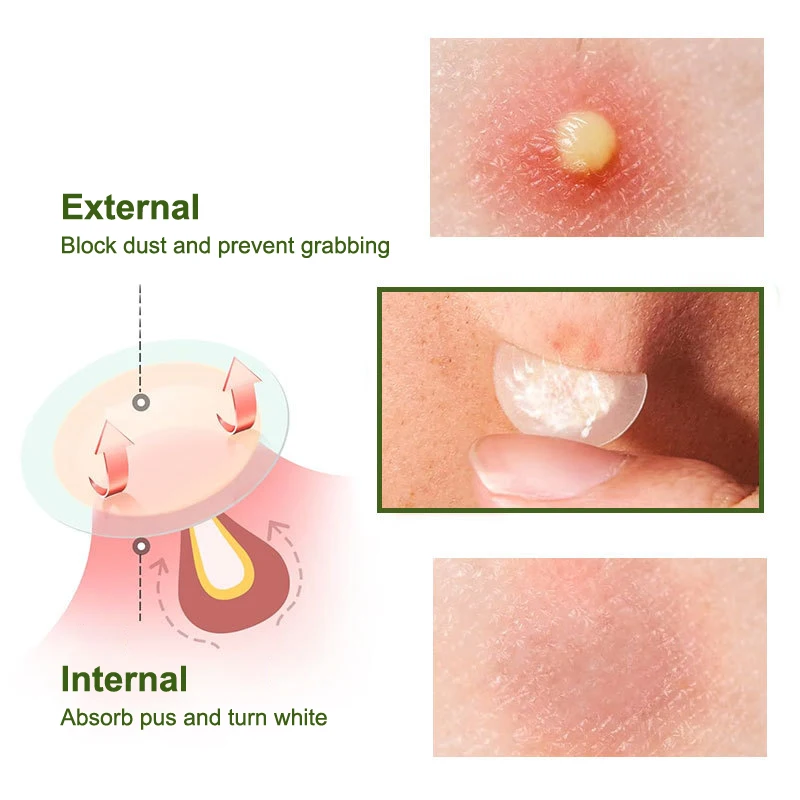 1/5Pcs Acne Patch Invisible Hydrocolloid Concealer Acne Patch Light Breathable Suction Pus Essential Oil Acne Patch