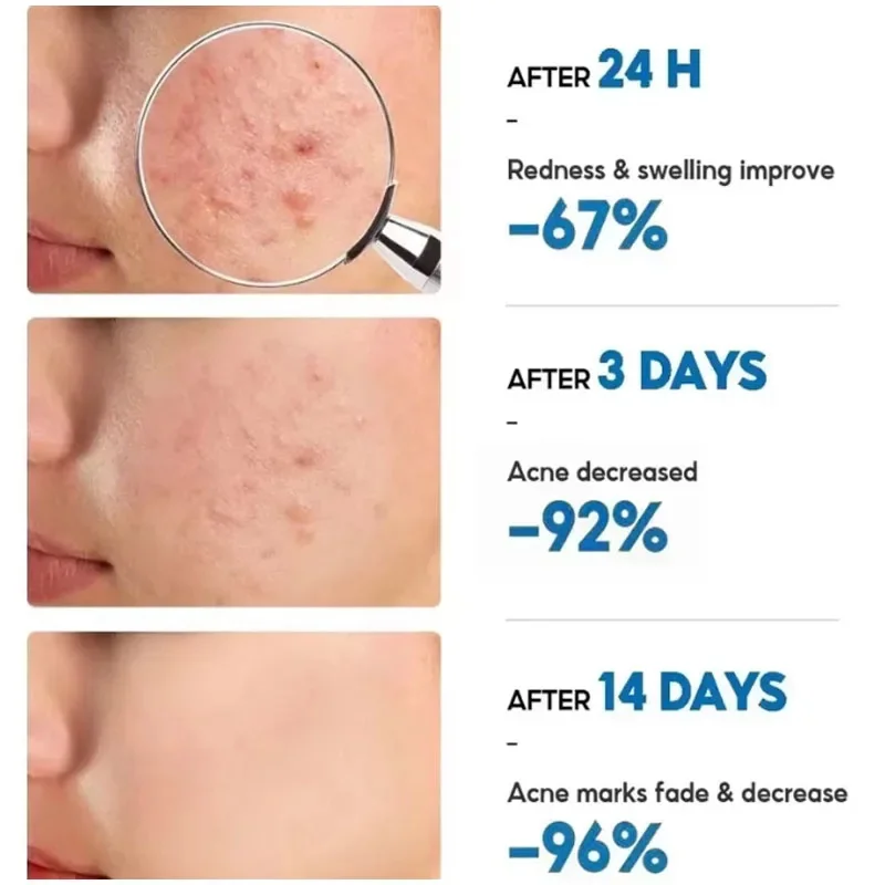 Effective Acne Removal Cream Anti-Acne Repair Redness Pimple Spots Gel Deep Cleaning Pore Oil Control Moisturizing Skin Care 30g