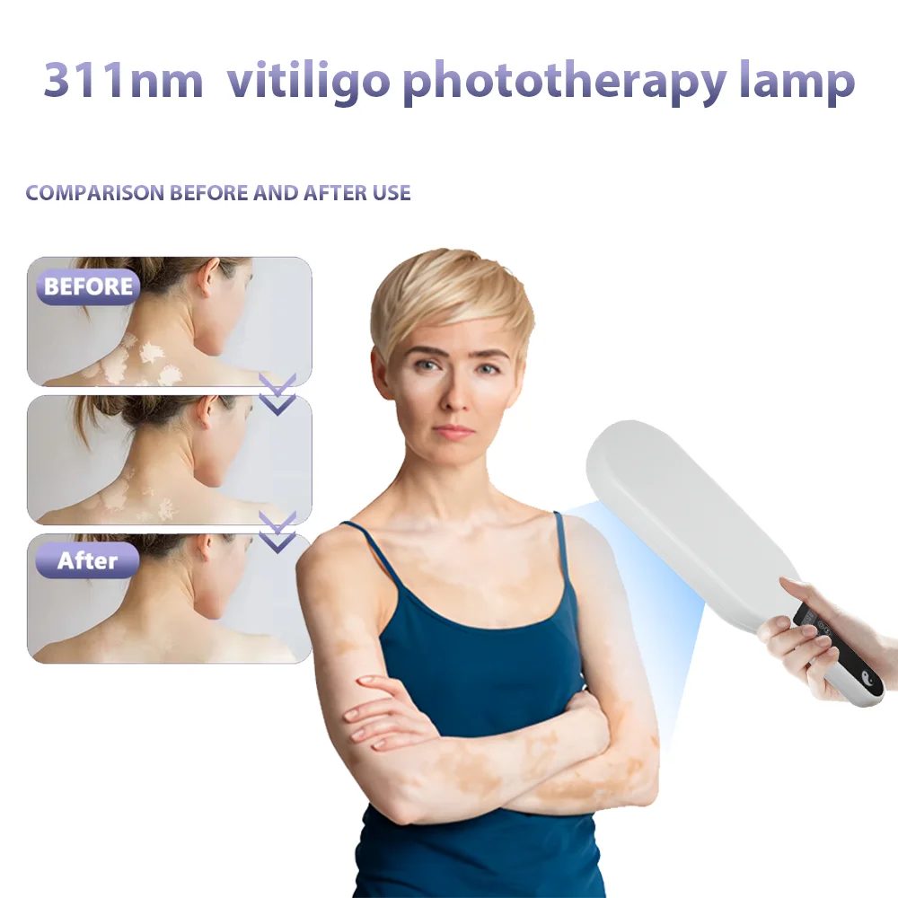 

311nm ultraviolet psoriasis skin care, portable home device for vitiligo, 311nmUVB phototherapy device, psoriasis phototherapy