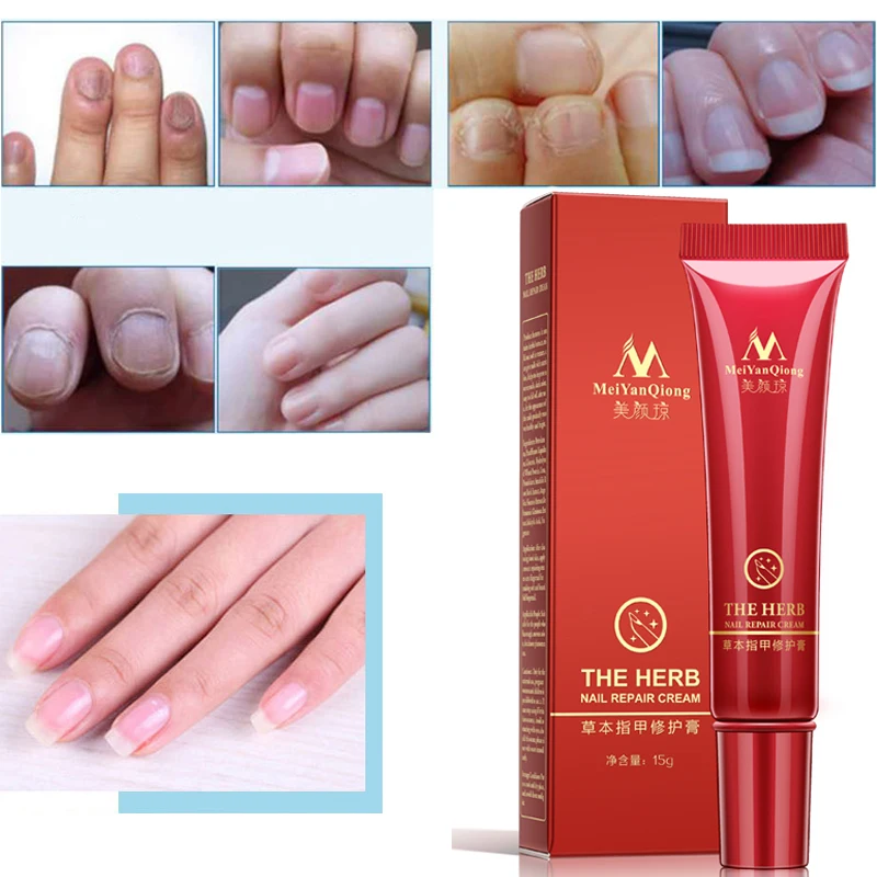 2 pçs 15g unguento de reparação de unhas fúngicas eficaz tratamento de unhas creme de cuidado diário antibacteriano onychomycosis paronychia vestir