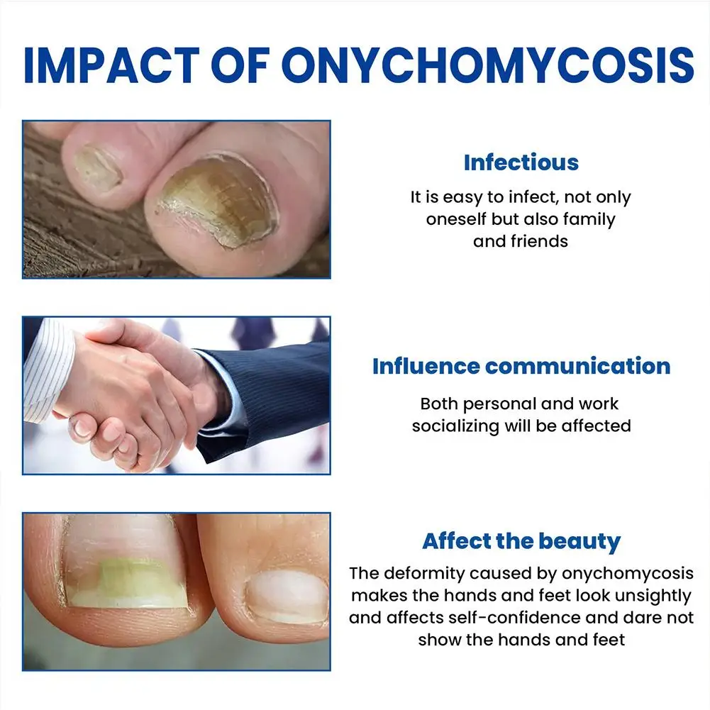 ملصقات علاج الفطريات لأظافر القدم ، إزالة البارونيشيا ، تصحيح الأظافر النامية ، أدوات العناية بالعناية بالأظافر ، 60 في كل صندوق