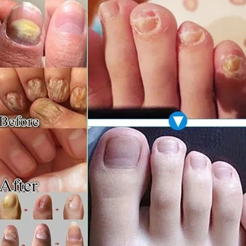 7 Day Nail Fungal Treatment Serum Foot Toe Nail Fungus Removal Essential Oil Anti Infection Onychomycosis Paronychia Repair Gel