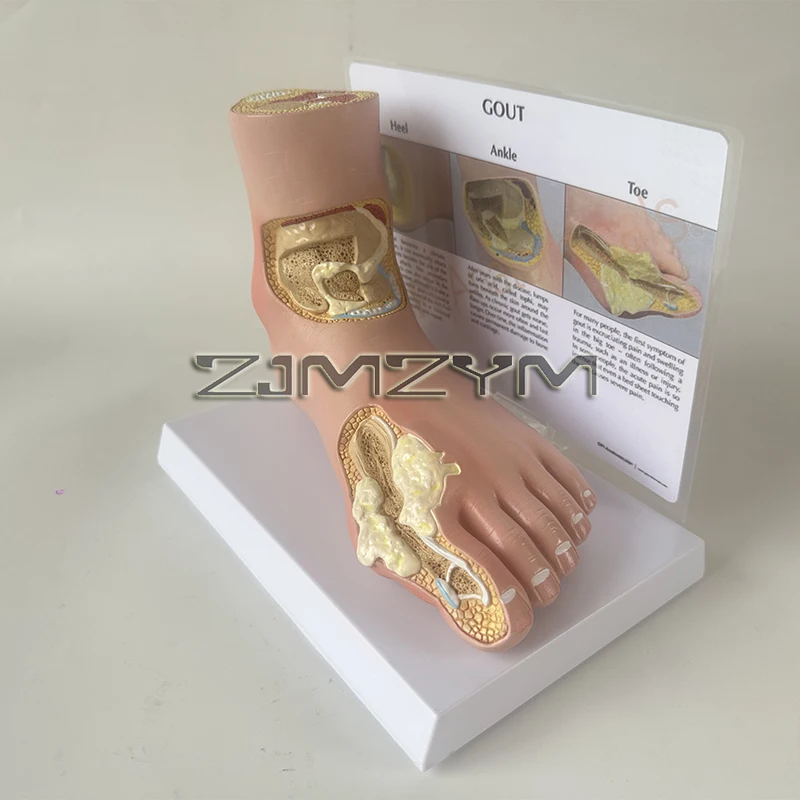 

Foot Gout Stone Model, Rheumatic Foot Joint Litholysis, Stone Foot Dissection, Joint Muscles Medicial Teaching Aids