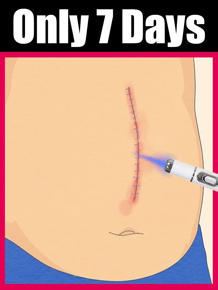 El juego de herramientas de luz azul de cicatrices puede decir adiós a cicatrices planas cicatrices de Filiform