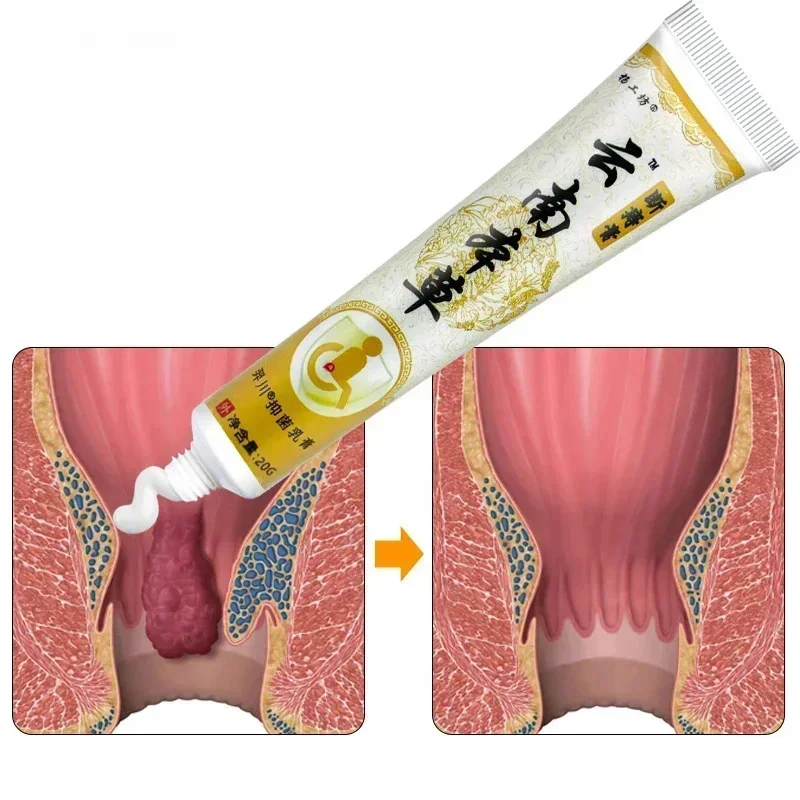 4pcs Hemorrhoid Herbal Ointment Hemorrhoid Removal Cream Anal Pain Relief Cream Antiinflammatory Anal Swelling Anal Tear S112