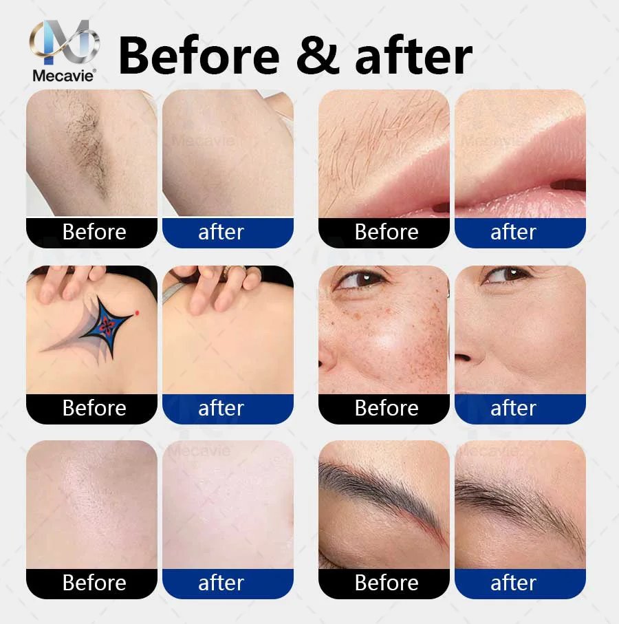 4 In 1 Soprano Titanium Ice Laser Hair Removal Device Alexandrite 808nm Diode Laser System Painless Permanent Body Hair Removal