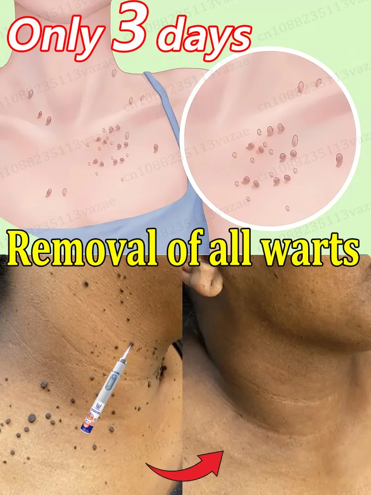 كونديلوما أكوميناتوم نات لانجرز إلى كومين #1