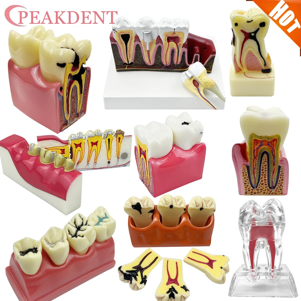 

4/6/8 Times Dental Caries Model Disease Teeth Dental Model for Dental Demonstration Model Dentist Teaching Dental Oral Research