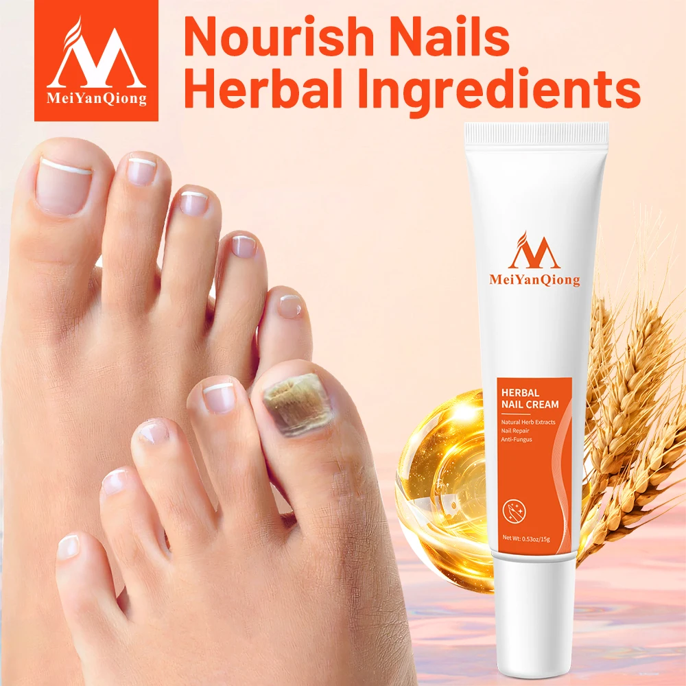 Trattamento delle unghie Onicomicosi Paronichia Piedi antiribaltamento Infezione delle unghie Buon risultato Trattamento cinese dei funghi delle unghie delle dita dei piedi