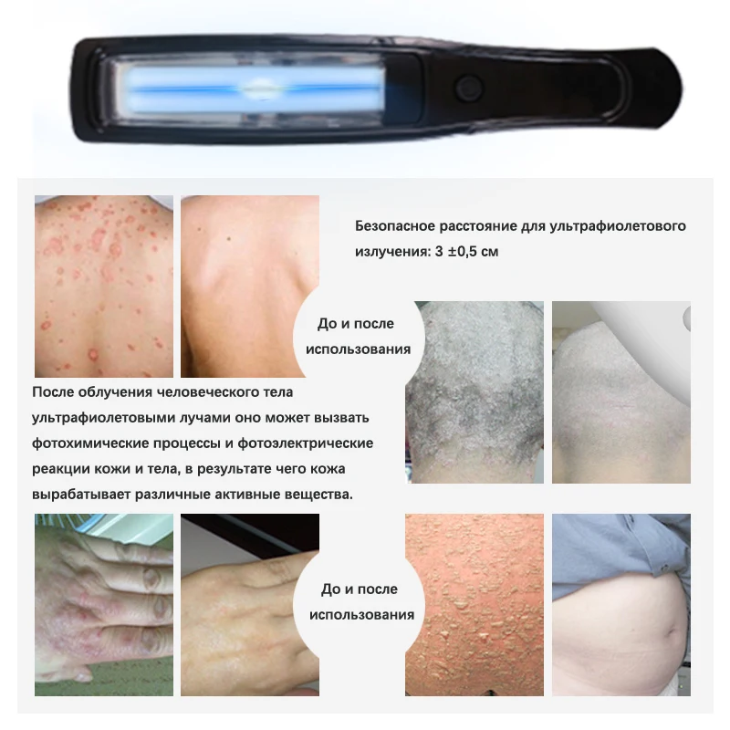 Lampada UVB per terapia Lampada per psoriasi Trattamento della pelle Luce 308NM Strumento per fototerapia vitiligine a banda stretta ultravioletta