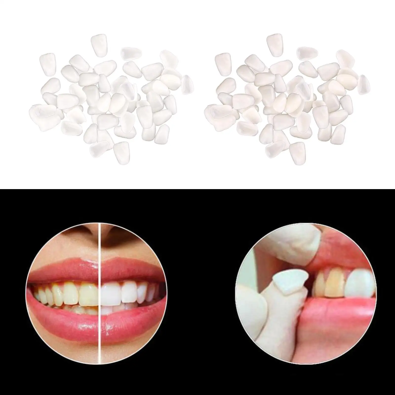 Dental Tooth Temporary Veneers Upper Anterior Front Resin