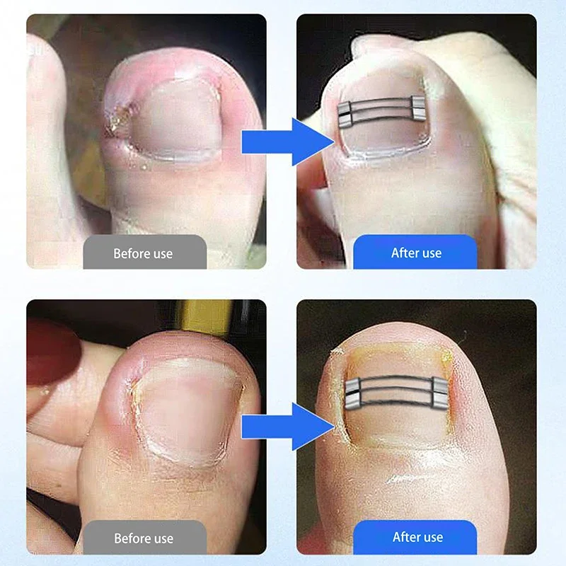 Corrector de uñas encarnadas, herramientas de sujeción, recuperación de pedicura, tratamiento de uñas encarnadas profesional, alisado de uñas encarnadas