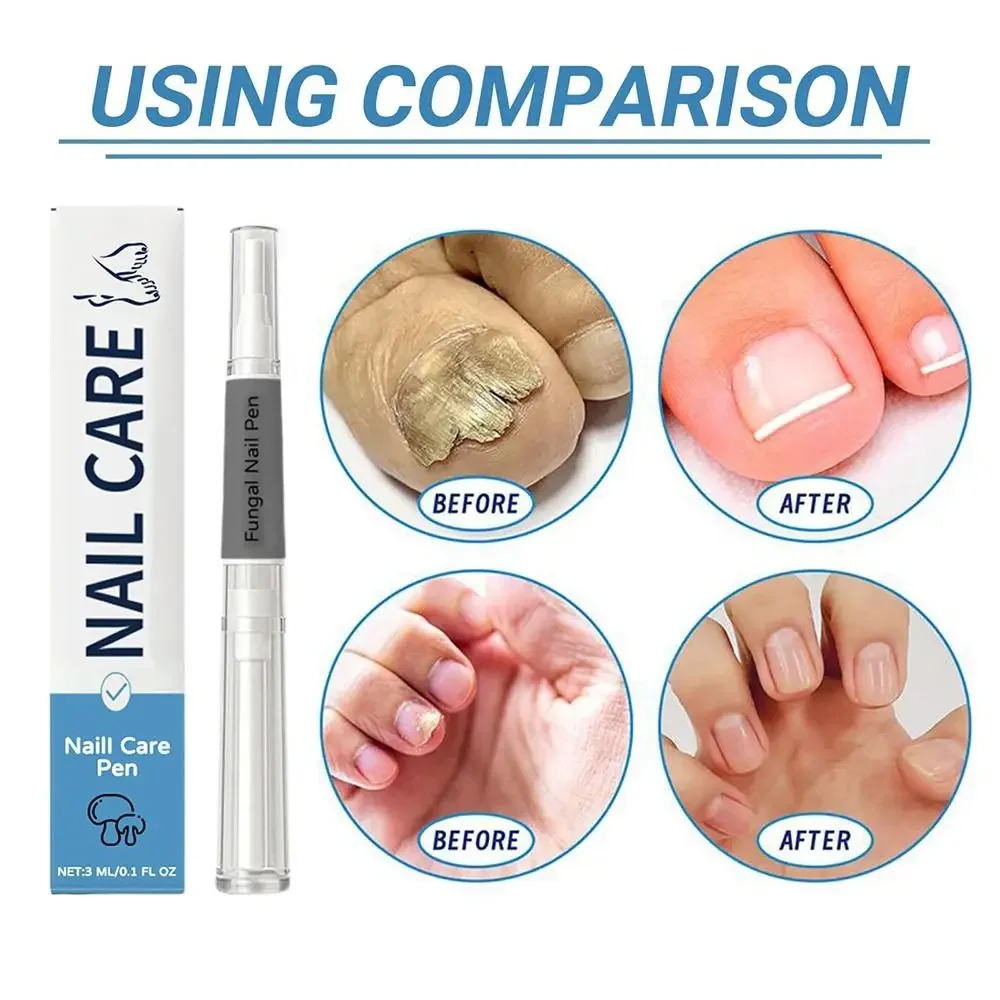 مصل علاج قلم فطريات الأظافر بزيت البشرة، تركيبة متقدمة، مصل الأظافر المتقدم للعناية بالأظافر، علاج أظافر القدم