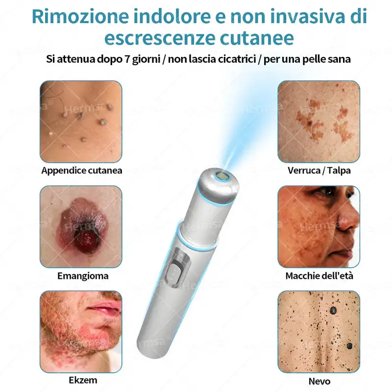Primo E: La Soluzione Innovativa per la Rimozione Non Invasiva di Talpe e Verruche