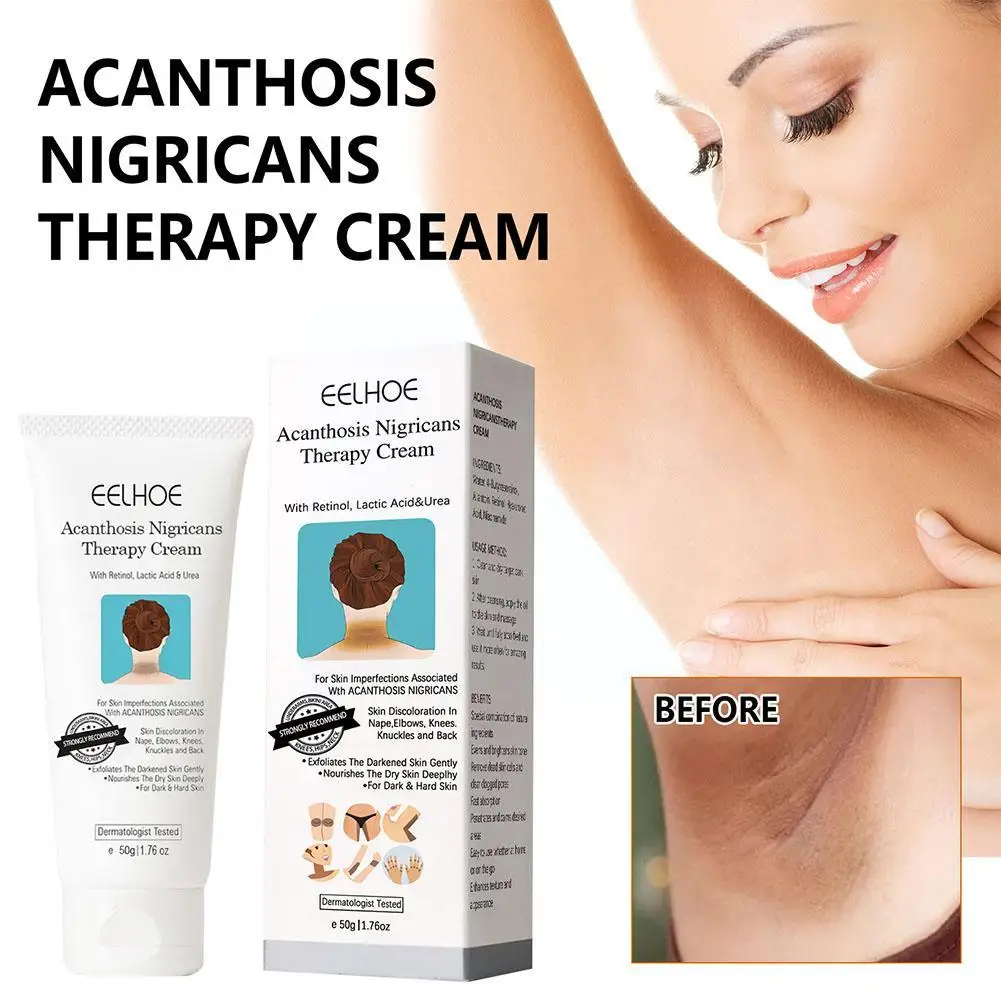 EELHOE Acanthosis Nigricans Therapy Cream Cream for Underarm Arm Knee Joint Black Moisturizing and Whitening Body Care Cream