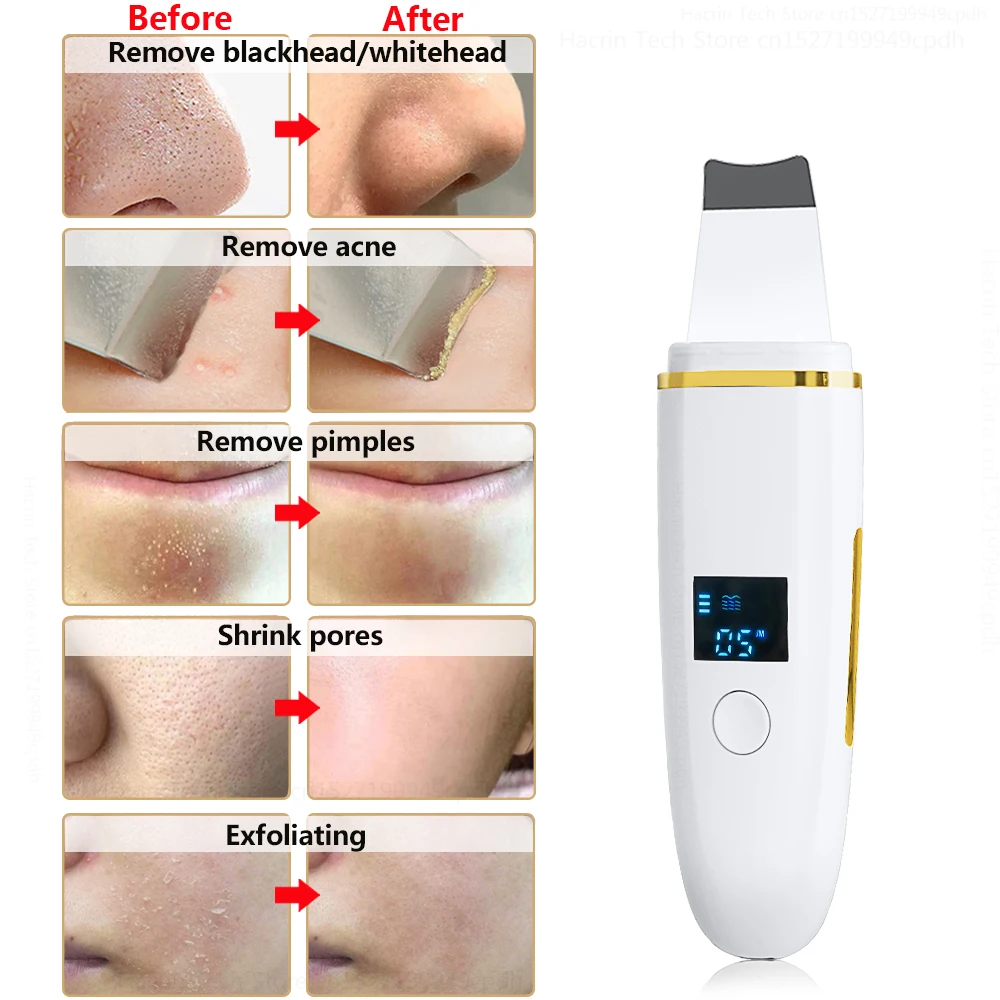 Ultrasonic Skin Scrubber Remover Blackhead Ultrasonic Peeling Facial Scrubber Shovel Deep Cleaning Face Lifting Remove Pore Acne