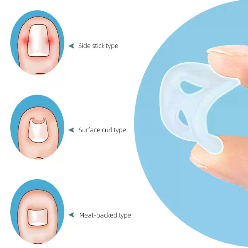 Силиконовый-инструмент-для-коррекции-вросших-ногтей-невидимый-инструмент-для-лечения-вросших-ногтей-эластичный-зажим-для-выпрямления-инструмент-для-педикюра