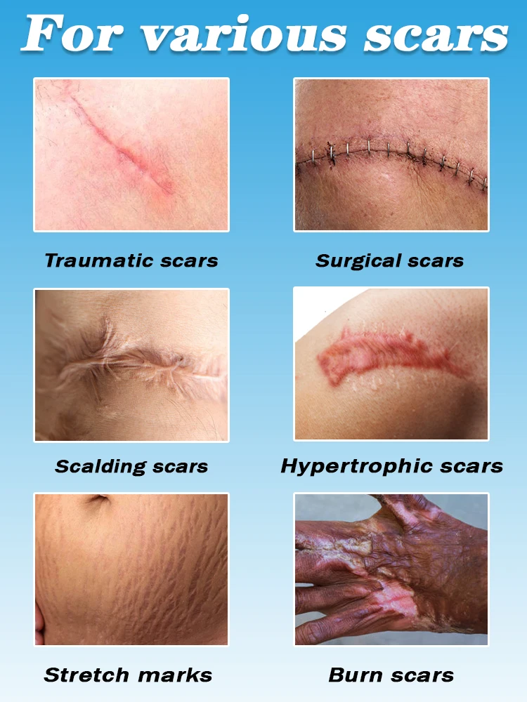 Crema milagrosa para cicatrices que deja tu piel como nueva
