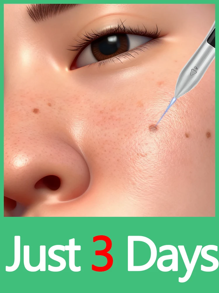 

2025 г., хорошо продается, инструмент для бородавок, лазерная ручка, решение бородавок, синий лазер