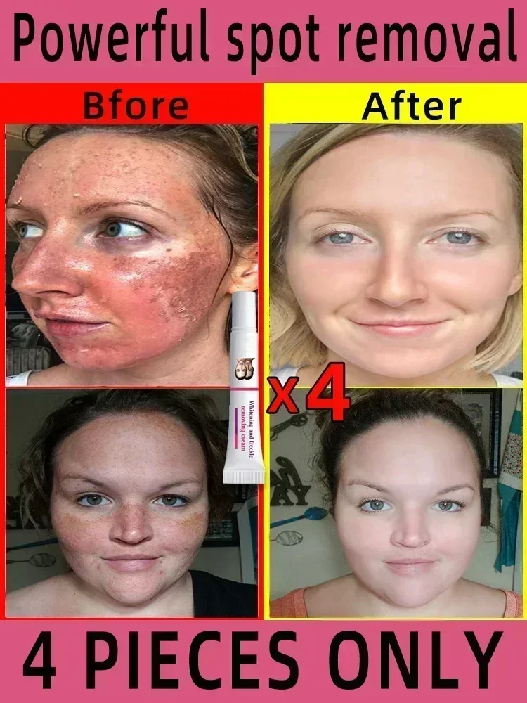 Facial Spots Cream Freckles Removal Skin Dark Spot Remove Melasma Age Spots Sunspots Whitening And Freckle Removing Cream