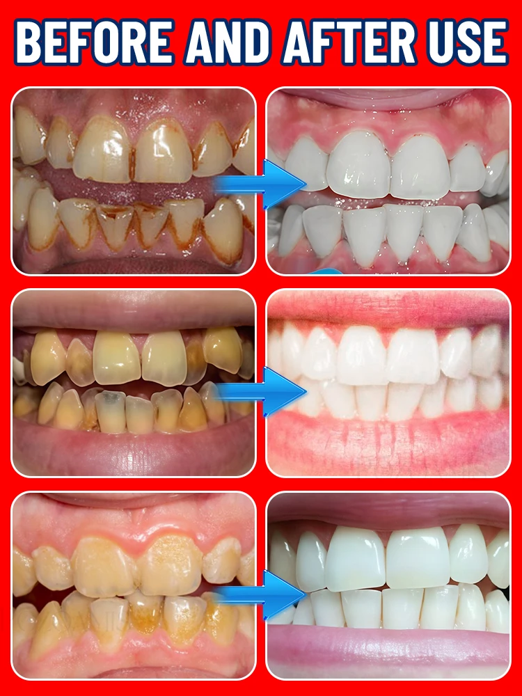 Cura orale, sbiancamento dei d - Teeth Whitening And Stain Removal recensione e prezzo